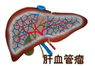 肝血管瘤