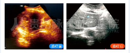 【贵阳血管瘤治疗案例】智能超导介入栓塞术治疗对比
