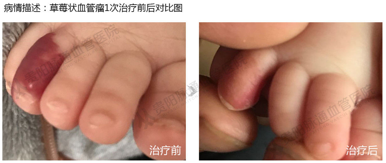 【贵阳血管瘤治疗案例】智能腔内综合治疗前后对比