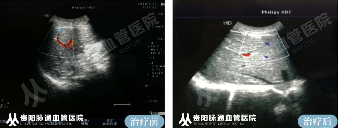 【贵阳血管瘤治疗案例】智能腔内综合治疗前后对比 3