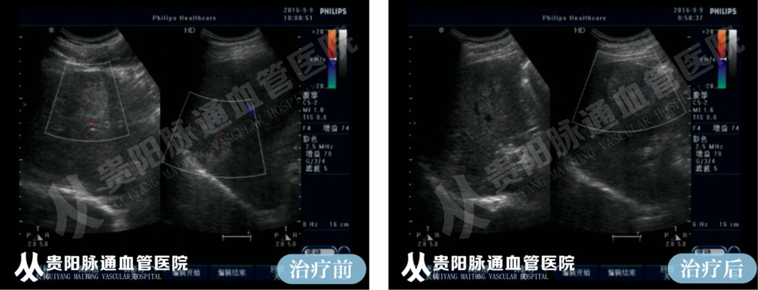 【贵阳血管瘤治疗案例】智能腔内综合治疗前后对比 4