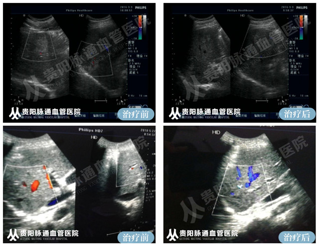 【贵阳血管瘤治疗案例】智能腔内综合治疗前后对比 