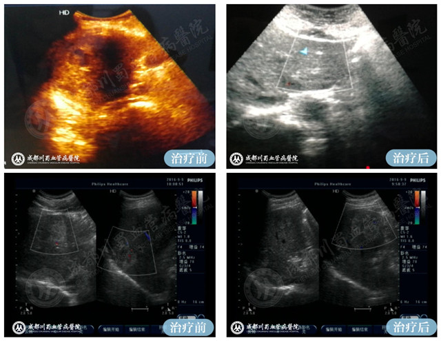 【成都血管瘤治疗案例】智能腔内综合治疗前后对比