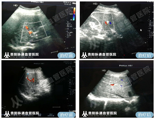 【贵阳血管瘤治疗案例】智能腔内综合治疗前后对比 6