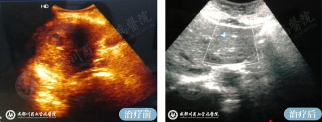 【成都肝血管瘤治疗案例】智能腔内综合治疗前后对比2