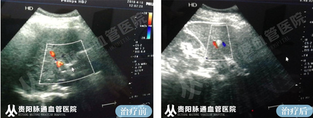 【贵阳血管瘤治疗案例】智能腔内综合治疗前后对比 2