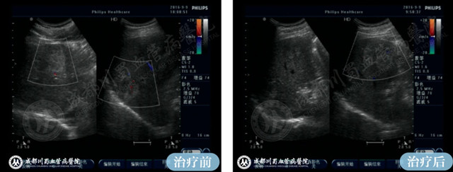 【成都肝血管瘤治疗案例】智能腔内综合治疗前后对比4