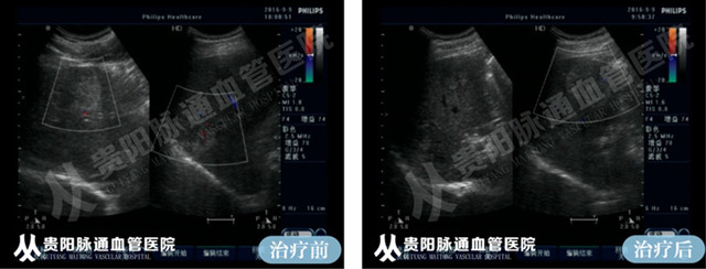 【贵阳血管瘤治疗案例】智能腔内综合治疗前后对比 4